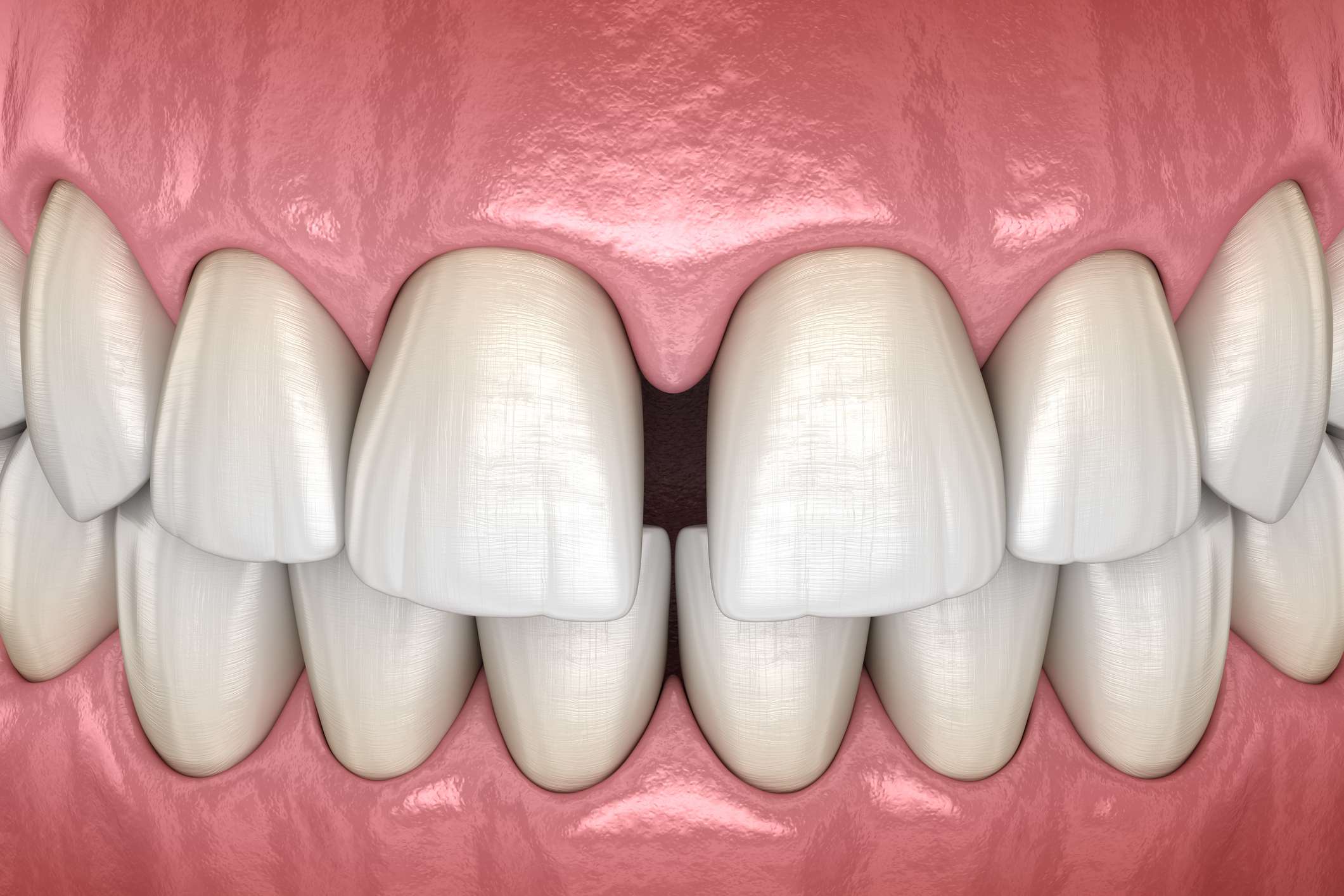 Diastemas dentales: qué son, causas y tratamientos