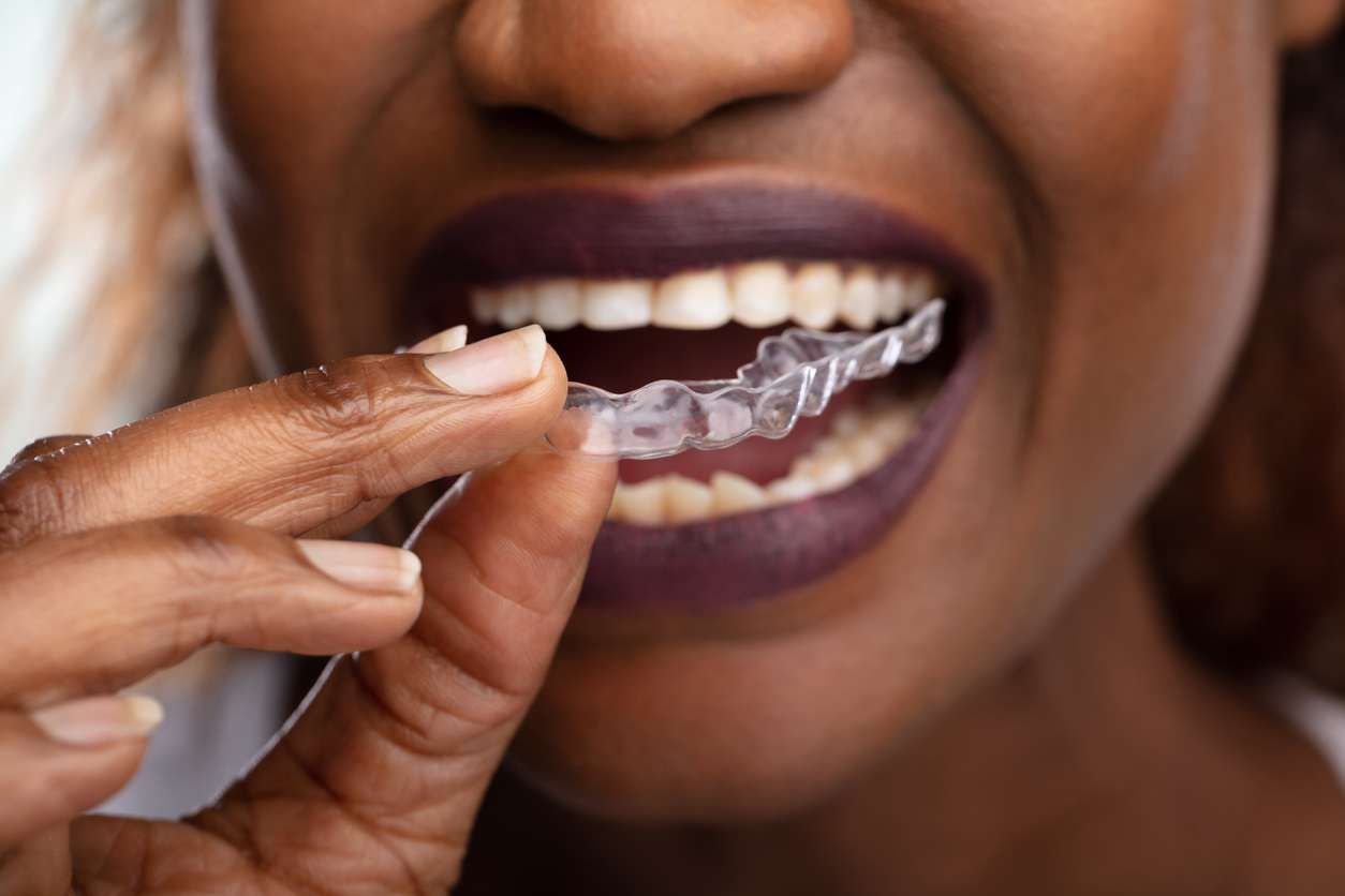 Descubre los beneficios de la ortodoncia invisible
