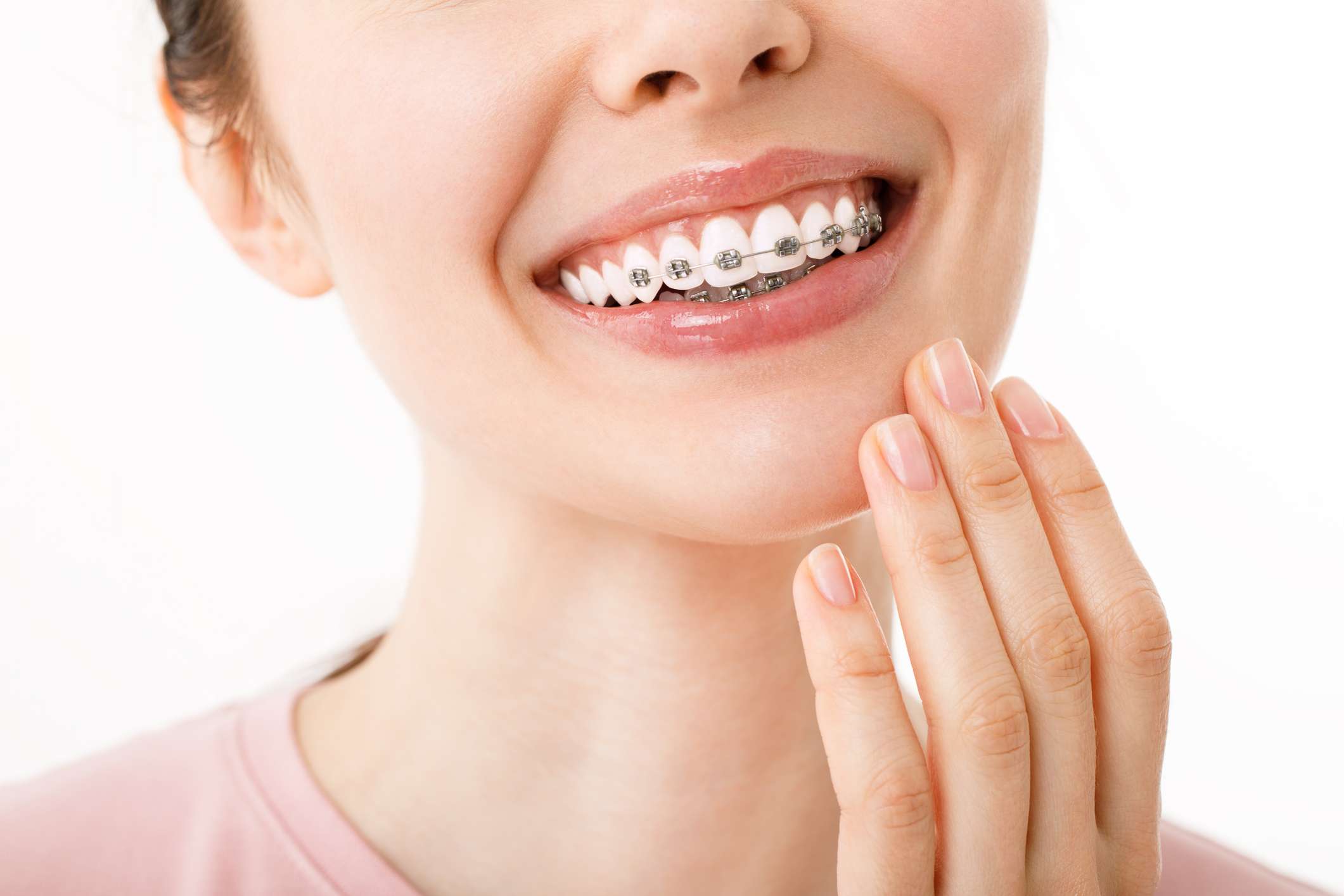 4 dudas frecuentes sobre la ortodoncia con brackets en Madrid