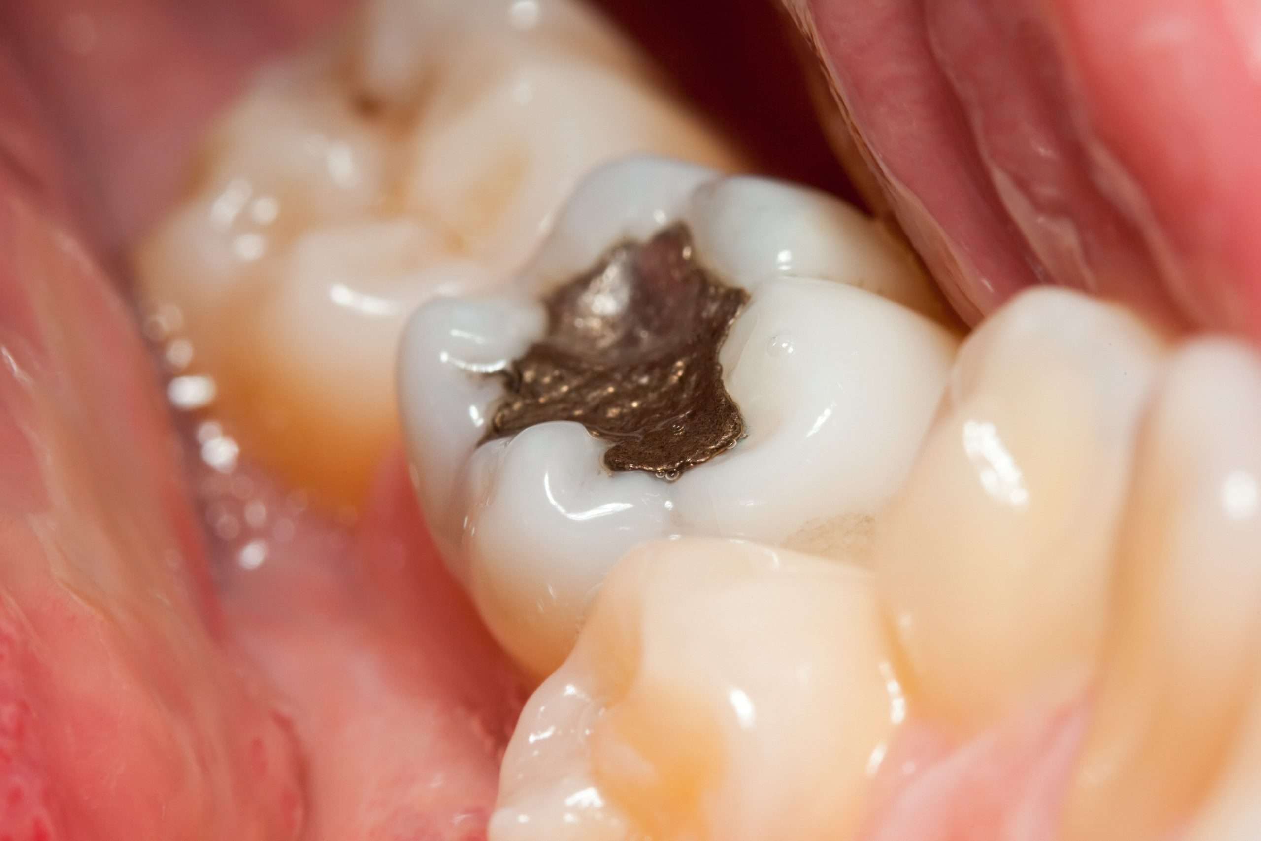 Todo lo que debes saber sobre los empastes dentales en Madrid