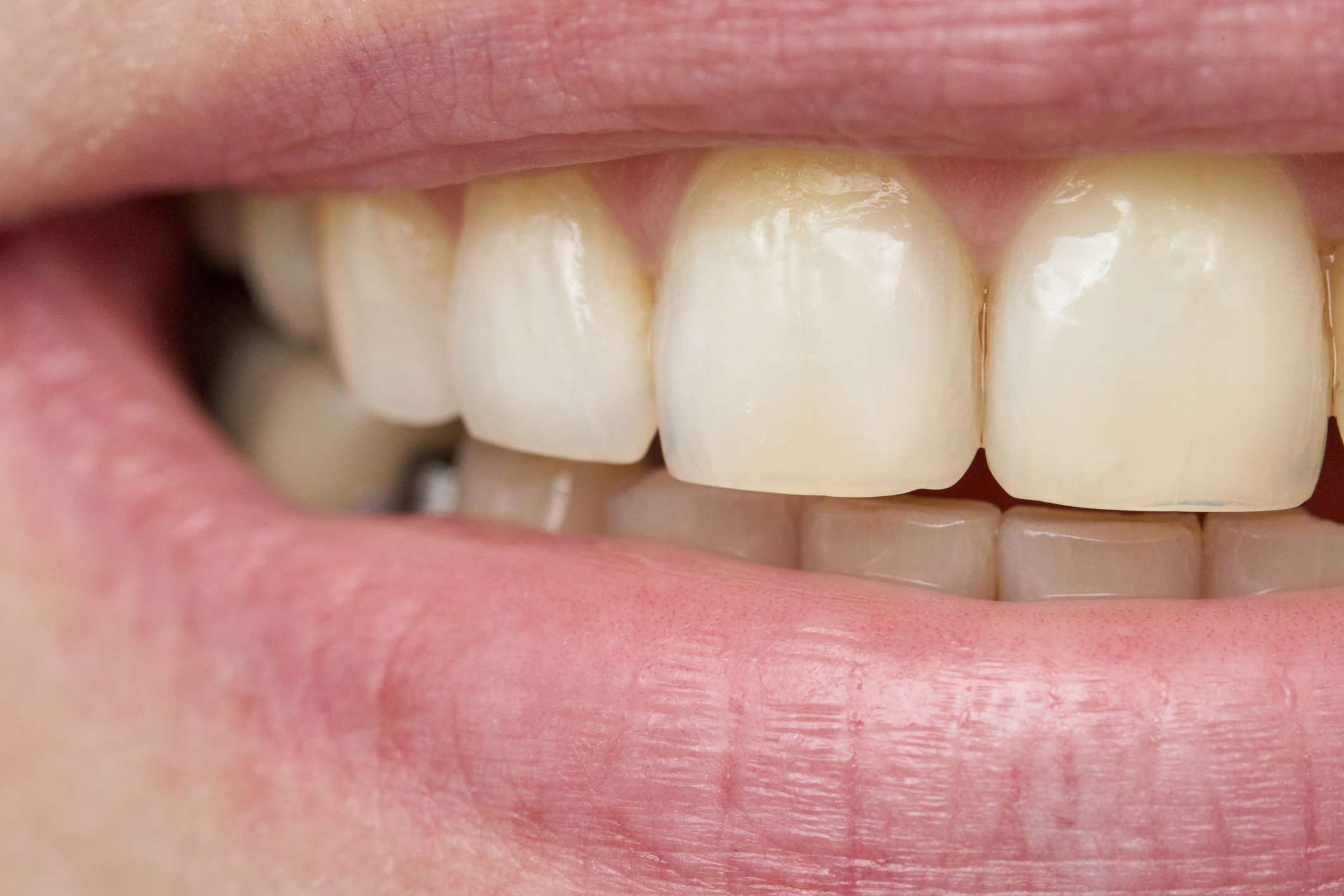 ¿Por qué algunas personas tienen los dientes transparentes en los bordes?